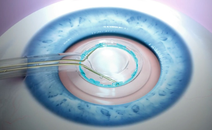 Zepto Robotic Capsulotomy